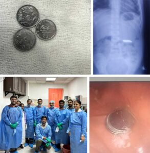 Safdarjung Hospital Achieved a Milestone by Launching the State-of-the-Art Dedicated Pediatric Endoscopy Suite and 10-bedded Day Care